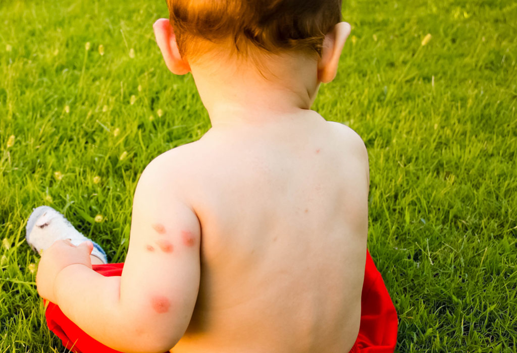 Produse anti-tantari. Solutii si repelente naturale: sprayuri anti-tantari, lotiuni calmare intepaturi